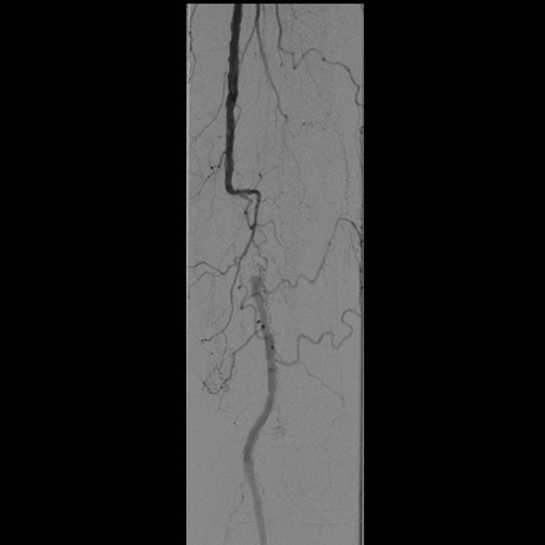Verschluss Arteria femoralis (Oberschenkelarterie) mit Umgehungskreislauf