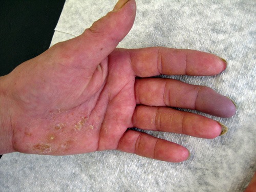Fingerarterienverschluss